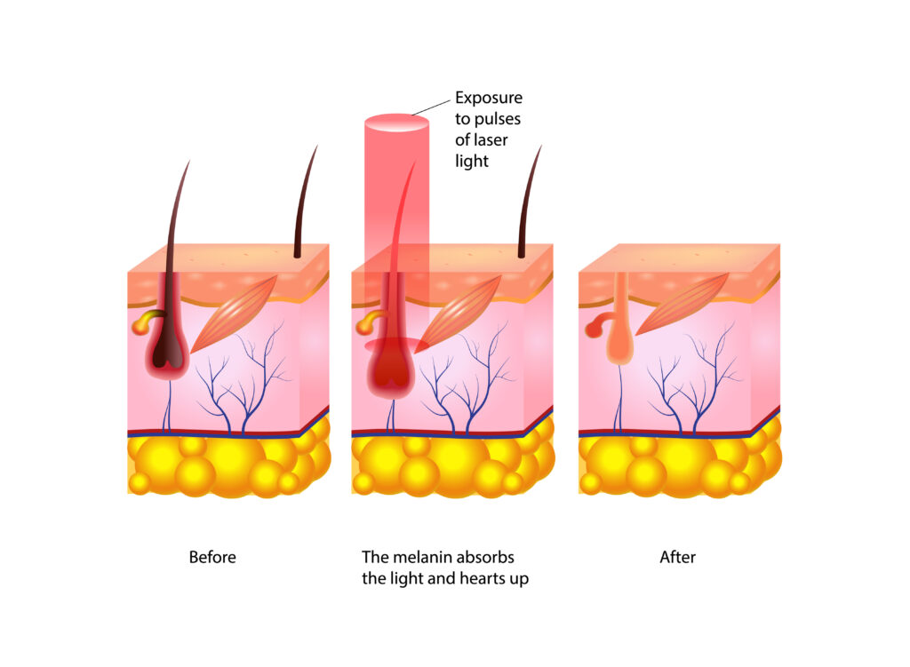 Laser Hair Removal The Wicklow St Clinic